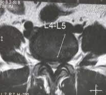 Spinal Canal Stenosis: What does it mean and how to deal with it?