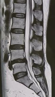 Spondylosis: what does it mean?